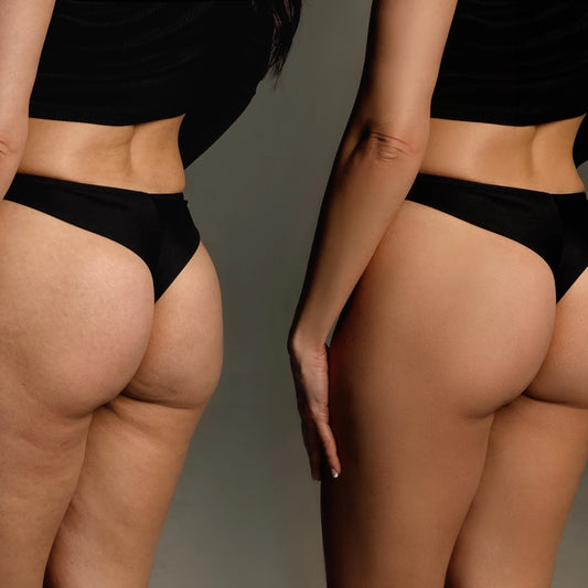 The truth and misconceptions about cellulite.